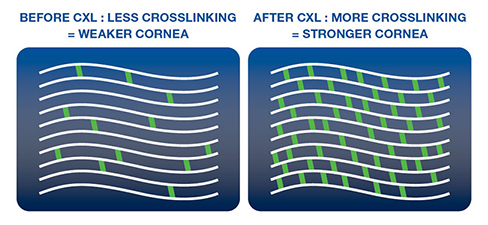 graphic of before corneal cross linking and after